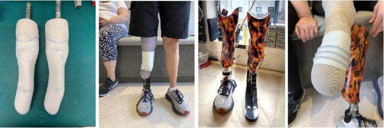 What Materials Are Used For Prosthetics? | APC Prosthetics