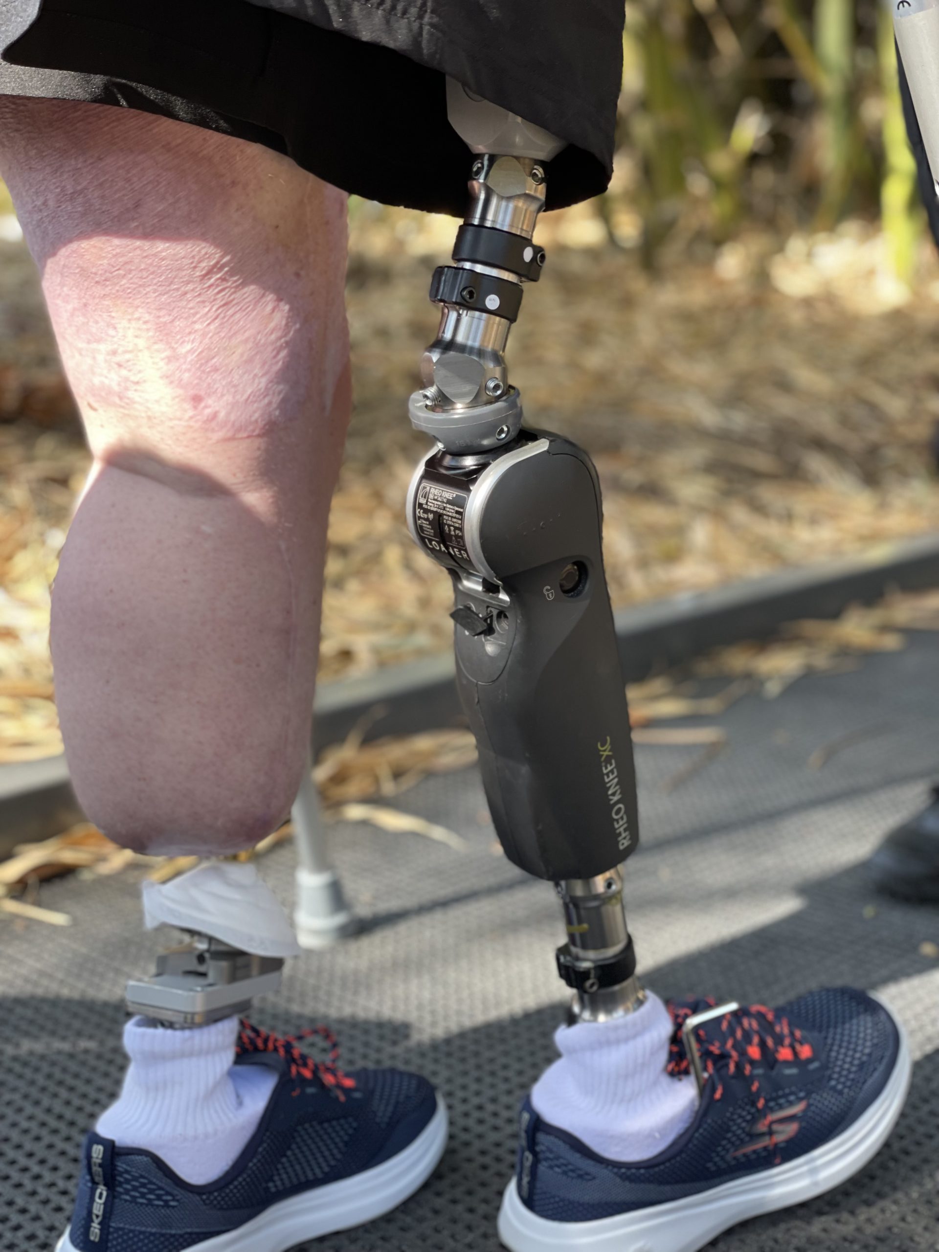 Prosthetic Leg - Leg Prosthesis | APC Prosthetics