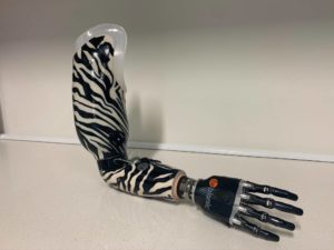 Example of a prosthetic hand